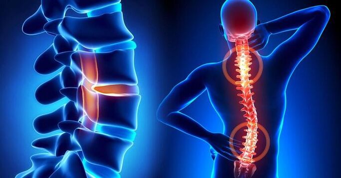 sāpju lokalizācija osteohondrozē