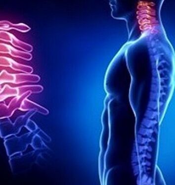 Dzemdes kakla osteohondrozes cēlonis var būt kakla traumas