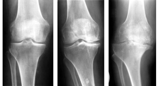 Obligāts diagnostikas pasākums, nosakot ceļa locītavas artrozi, ir rentgens